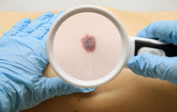 皮膚に現れた「できもの」の正体（4）【基底細胞がん】黒々としたいびつな形のホクロはがんかもしれない