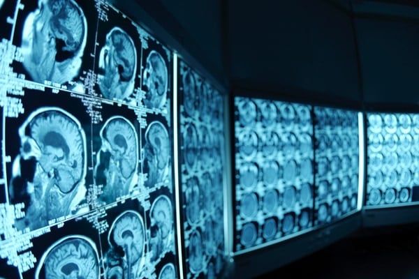 最近生まれた人々は、以前の世代に比べて、認知症になる可能性が低い