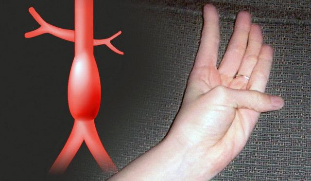親指の伸びで「大動脈瘤の有無」がすぐ分かる!?簡単な片手診断テスト