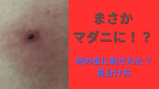 虫刺されの痕に「血豆」...これってもしや“マダニ”！？何の虫に刺されたのか「見分ける方法」「適切な処置」教えます【画像閲覧注意！】