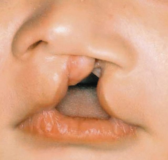 口唇口蓋裂の医療助成「18歳で打ち切らないで」に反響　SNSに40人の切実メッセージ「子どもたちに希望を」