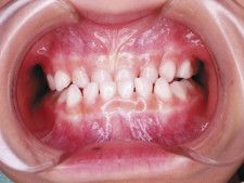 【治療前】下の歯が前に出ている「反対咬合」の４歳男児